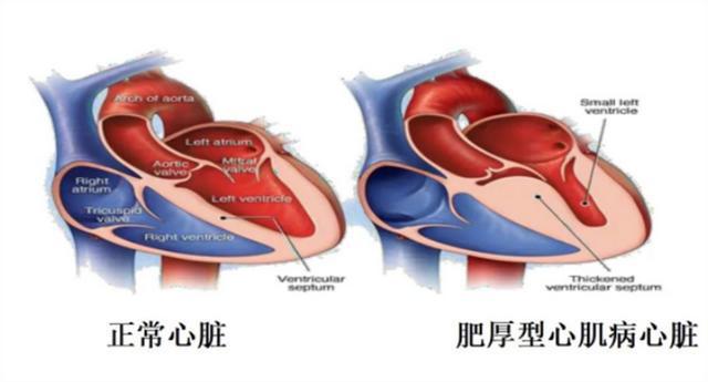 肥厚心肌病最新治疗步骤指南与策略解析