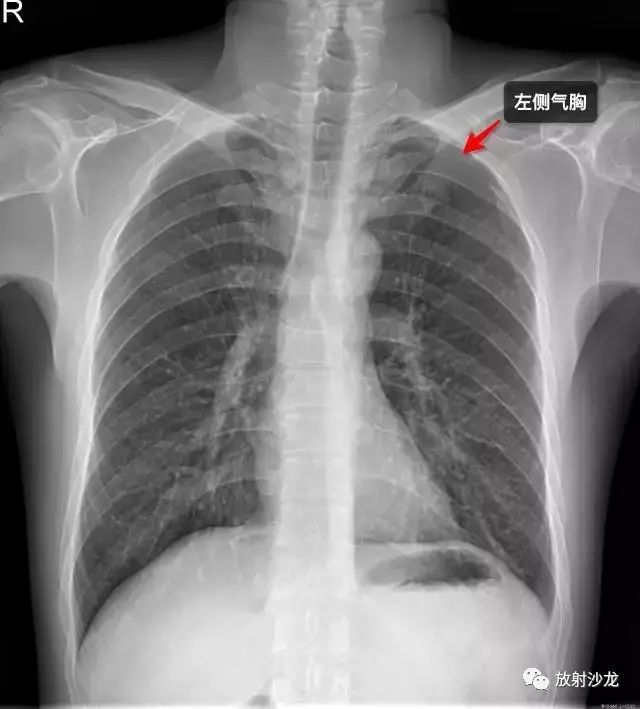 肋骨骨折最新健康教育知识普及