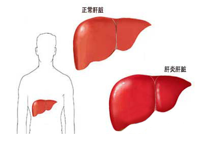 最新肝癌治疗方法探讨